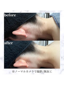 エルアンドエル(L&L)/うなじスッキリ!