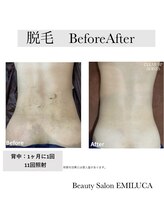 エミルカ(EMILUCA)/レディース全身脱毛