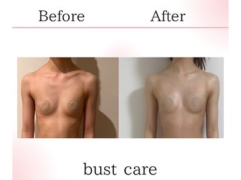 サロンツキ(salon tuki)/バストアップ/バストケア症例