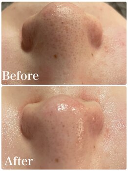 ミーアップ(Me up)/毛穴ケアも得意です◎