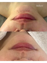 ベリスユイット(BELLIS HUIT)/【毛穴吸引×ハーブピーリング】