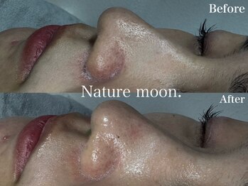 ナチュールムーン(Nature moon.)/毛穴洗浄