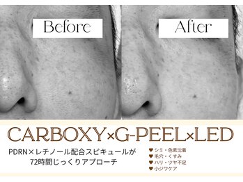 ステラ(STELLA)の写真/小さな毛穴悩みも、毎日の積み重ねで大きなストレスに。隠すメイクから、毛穴を気にしない素肌へ!/松阪市