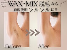 プラチナワックス(Platine Wax)/【わき】MIX脱毛