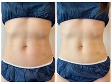 メディカルエース(MedicalAce)/痩身　看護師ボディ　ハイサーマ