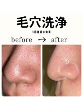 グラシア 宇土店(gracia)/毛穴専門店