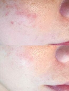 ラエッセ 恵比寿(LAESSE)/毛穴・美白専門店 LAESSE 恵比寿