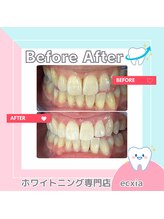 エクシアホワイトニング 札幌中島公園店/BeforeAfter［ホワイトニング］ 