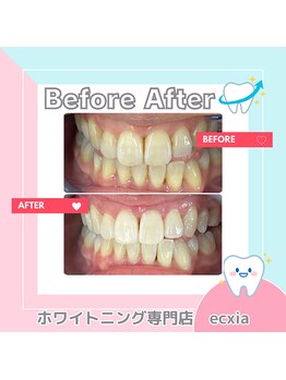 エクシアホワイトニング 札幌中島公園店/BeforeAfter［ホワイトニング］ 