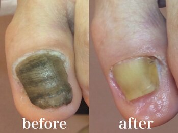 ドクターネイル爪革命 札幌本店/症例紹介5 肥厚爪