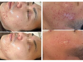 ニコリ 大宮(NICORI)/【ハーブピーリング＋プラズマ】