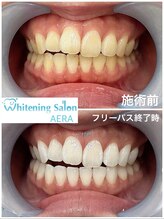 アエラ(AERA)/【フリーパスコース比較写真】