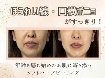 ムーンサン(Moon sun)の写真/年齢を感じ始めた貴方へ。ソフトハーブピーリングで若々しくハリのある肌を目指そう★