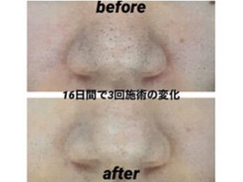 《毛穴悩み》徹底改善10STEP(毛穴洗浄+生コラ導入)90分\4400