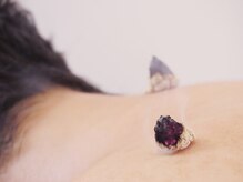 晴レヤカ鍼灸治療院/冷え性・女性のお悩みに