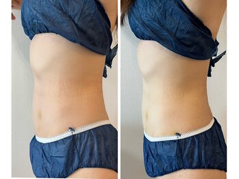 メディカルエース(MedicalAce)/痩身　看護師ボディ　ハイサーマ