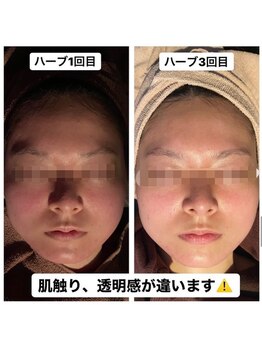 マーズ(Mars)/ホワイトハーブピーリング