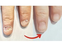 巻き爪専門ラボ 名古屋栄店/深爪育成