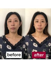 サロンチオリ 烏丸(Salon Chiori)/《50代》輪郭引き締まる小顔矯正