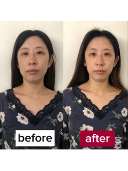 サロンチオリ 烏丸(Salon Chiori)/《50代》輪郭引き締まる小顔矯正