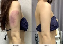 スラリ(SLARI)/【二の腕　脂肪冷却期間1ヶ月半