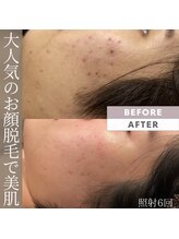 モアトゥインクル 福山宮通り店(MORE twinkle)/毛穴洗浄