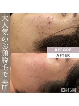 モアトゥインクル 福山宮通り店(MORE twinkle)/毛穴洗浄