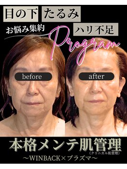 ノーブルノアール(Noble noir)/フェイスライン復活♪