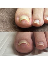 リリ(lili)/巻き爪矯正1回目（左親指）