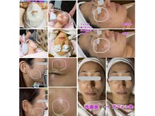 NEW光フォト一度お試しください小顔.リフトアップ.抗酸化.抗糖化