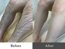 メンズオージー 岡山中区(men's O.G)/メンズ脱毛｜あし脱毛