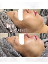 マウム(MAUM)/白玉肌管理