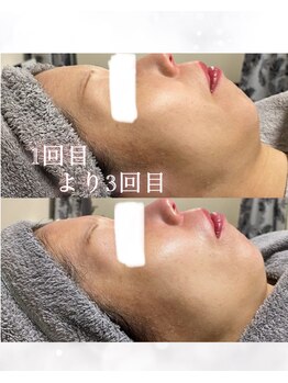 マウム(MAUM)/白玉肌管理