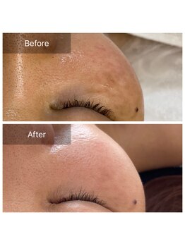 シファ(SHIFA)/シミ・くすみ・ニキビケア