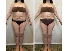 サロン ド フェイス モアナ(Salon de Faith Moana)/キャビテーション痩身【50代】