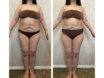 サロン ド フェイス モアナ(Salon de Faith Moana)/キャビテーション痩身【50代】