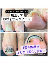 長岡巻き爪矯正センター/巻き爪矯正ビフォーアフター