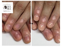 トイロ(toiro)/症例数50000件以上☆