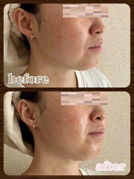 ベリーチェ(beliece)/脂肪分解エステ/ほほ・あご