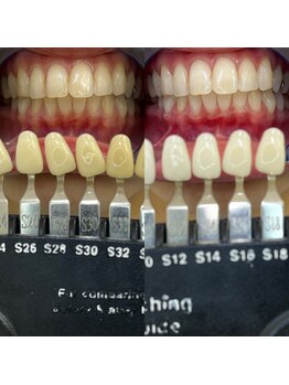 トウキョウスワーズ 池袋店(TOKYO SWRS)/#ホワイトニング #池袋 #渋谷