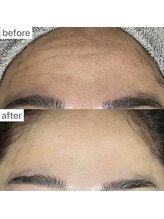 ユイット ルッカ(Huit Lucca)/ララピール×アクアダーマ