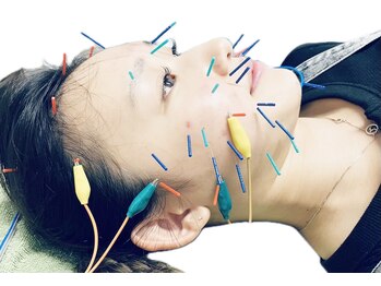 ハートテラス整骨院 鍼灸院/小顔リフトアップ美容鍼