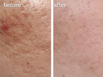 メルシア(merucia)/跡、ニキビケア、凸凹ケア