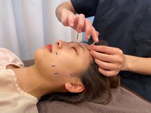 柿木園鍼灸 整体院/細い鍼で美容鍼を狙う