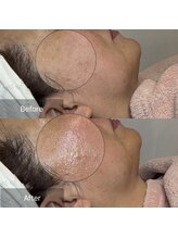 カノン(Kanon)/幹細胞導入で潤いツヤ肌に