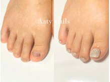 アーティネイルズ(Aaty Nails)/【深爪矯正】フット