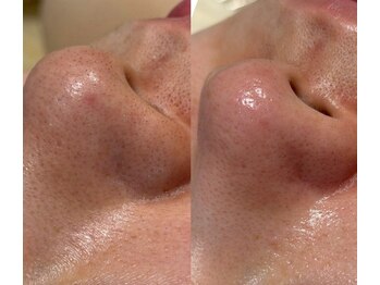 リノア(Lino'aka)/毛穴トルネード洗浄３回の結果