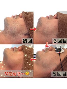 サロン 半田店(SALON)の写真/きちんと抜ける脱毛技術で理想の肌へ。学生さんにも人気で通いやすいエステ店♪