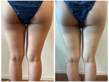 メディカルエース(MedicalAce)/痩身　看護師ハイサーマ　ボディ