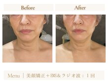 ムーア(muua)/美顔矯正×ラジオ波＆EMS